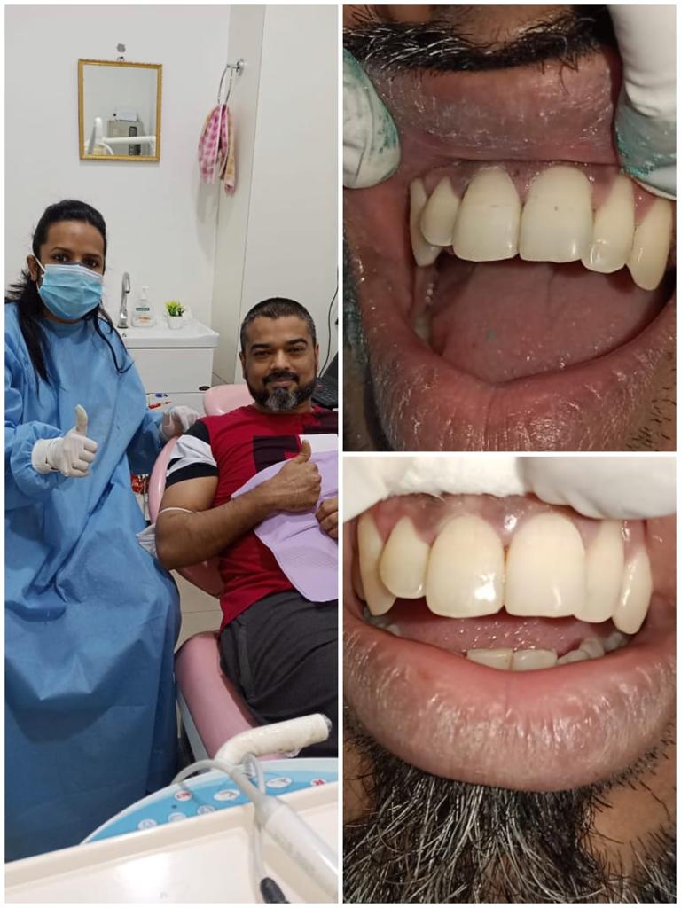 Dental laminates patients
